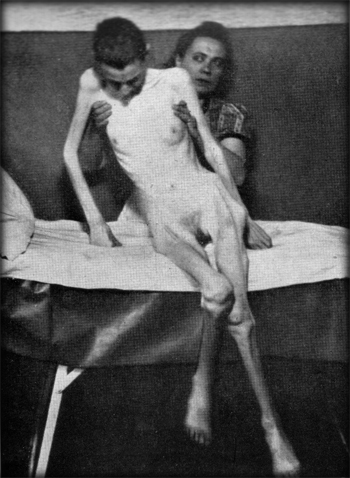 An inmate of Auschwitz hospital after liberation